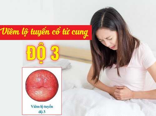Viêm lộ tuyến cổ tử cung cấp độ 3 